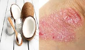 Traitement Naturel D Eczema A L Huile De Noix De Coco Psoriasis Diet Eczema Diet Treat Psoriasis
