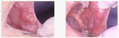 Image result for Labial mucosa