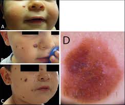 Image result for Spitz Nevus