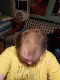 In some cases, thinning hair is linked with diet, nutrient deficiencies, or hereditary hair loss. Advice Should I Cut My Hair Short Or Would That Make It Super Obvious I M Going Bald It S So Thin On Top But Thick On The Sides Idk What To Do