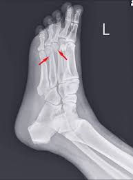 Image result for Metatarsal