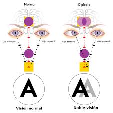 Image result for Diplopia