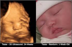 3d Ultrasound Photo Side By Side Comparisson To Newborn Baby 3d Ultrasound Baby Ultrasound Ultrasound