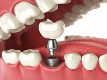 Dental Implants product image