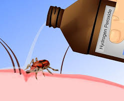 How To Remove A Tick Ticks Cleaning Hacks Life Hacks