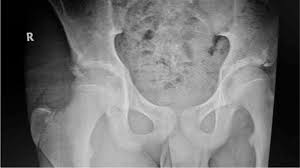 The causes of hip fracture are very different in young and elderly patients. Pelvis Anteroposterior X Ray Shows A Right Anterior Inferior Iliac Download Scientific Diagram