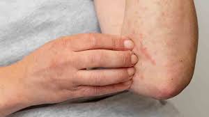 Image result for Neurodermatitis