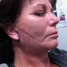 What is the Outcome of This Lateral Sweep?