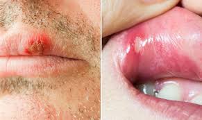 The cold sores you may find on your mouth are, in fact, herpes (literally caused by the herpes simplex virus or hsv). Which Is Contagious Your Canker Sore Or Cold Sore Health Essentials From Cleveland Clinic