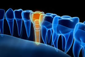 Coverage under your medical plan may be possible, depending on the insurance plan and/or cause of tooth loss. Does Dental Insurance Cover Dental Implants In Lisle