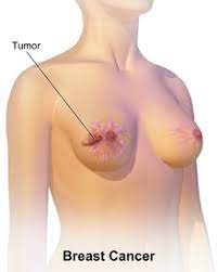 Breast cancer — comprehensive overview covers prevention, symptoms, diagnosis doctors know that breast cancer occurs when some breast cells begin to grow abnormally. Breast Cancer Wikipedia
