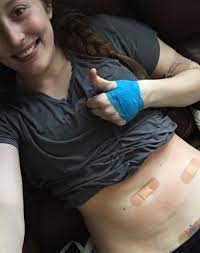 Stomach or gastric cancer develops in the inner lining of the stomach. Reddit I Did It Three Little Cuts Only 30 Minutes And I M Never Having Children Childfree