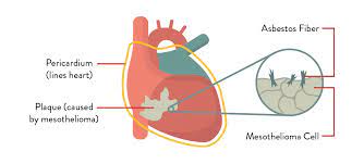 What are the more severe symptoms? Pericardial Mesothelioma Facts For You To Know Mesothelioma Feed