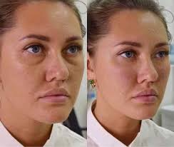 Inkless tattoo for stretch marks process?