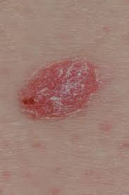They are due to the development of abnormal cells that have the ability to invade or spread to other parts of the body. Psoriasis Or Skin Cancer How To Tell The Difference