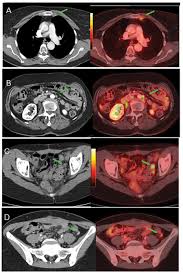 It results in abnormal cells that have the ability to invade or spread to other parts of the body. Staging Recurrent Ovarian Cancer With 18fdg Pet Ct