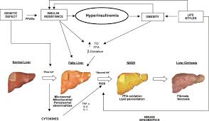 Liver Cirrhosis