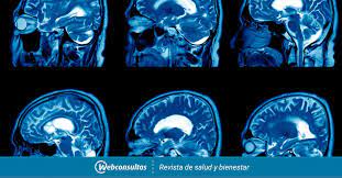 This definition means encephalitis is different from meningitis, which is defined as inflammation of the layers of tissue, or membranes, covering the brain.; Diagnostico De La Encefalitis Salud Al Dia