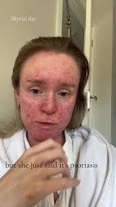 Skyrizi day. Infusion 1 #skyrizi #biologic #psoriasis #guttatepsoriasis  #plaquepsoriasis #autoimmunedisease