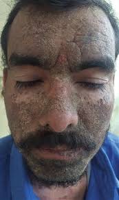 Tropical Diseases of the Skin