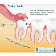 Much of higher rate of people wants their wisdom to get uprooted. Wisdom Teeth Complications Ealing Extractions Acton Hanwell