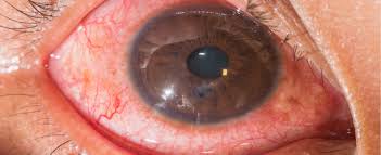 Image result for Eye Pain