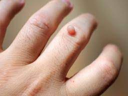 Viruses and other germs can linger on surfaces long after someone touches them. Warts Causes Types And Treatments
