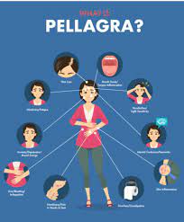 Pellagra, Gluten, & Vitamin B3 Deficiency - Gluten Free Society