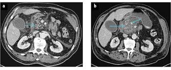 A ct scan with contrast uses certain substances that are given orally or intravenously before the scanning procedure, in order to improve visibility of resultant images. Mistakes In Acute Abdominal Ct And How To Avoid Them Ueg United European Gastroenterology
