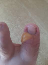 Mosquito bite on toe : rpopping