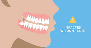 Can i remove them myself? How Long Does It Take To Heal After Wisdom Teeth Removal Aaoms