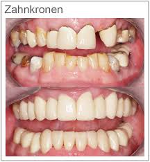 Für die höhe des zuschusses ist auch entscheidend, ob der zahn im sogenannten sichtbereich liegt. Preise Und Eigenschaften Von Zahnkronen Helvetic Clinics Budapest