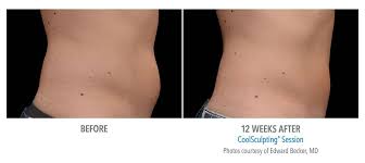 Before And After Coolsculpting Male Love Handles 12 Weeks Cool Sculpting Love Handles Love Handle Workout