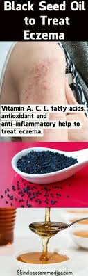 Using Black Seed Oil For Eczema Is An Effective Remedy You Just Need To Mix Honey Or Acv Or Lemon Juice Wit Oils For Eczema Black Seed Oil How To Treat