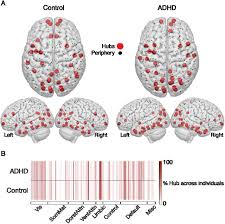 This means there are deficits in the adhd brain that affect a child's development. Adhd Symptoms Map Onto Noise Driven Structure Function Decoupling Between Hub And Peripheral Brain Regions Biorxiv