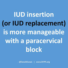 Image result for Paracervical Block