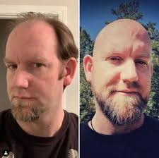 I realise hair loss is pretty much genetic, however i'm convinced it has been premature due to heavy stress over the last few years or possibly i did not look after it feels the most bs thing happening so early on, and might sound silly for a guy but i really love my hair, more than any other physical feature. Balding Young How To Deal With Balding In Your 20s