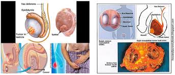 Sekiranya anda berisiko tetapi tidak mempunyai gejala dm, ujian kapillari darah dilakukan. Karsinoma Testis Pusat Sumber Dan Pendidikan Kanser Care