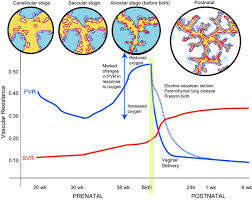 Image result for Delayed Transition from Fetal Circulation