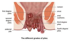 Image result for blood in stool human poop