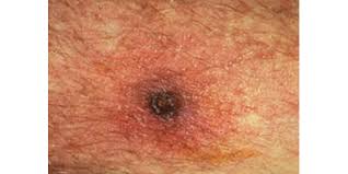 Typhus is a rare bacterial infection that people can acquire from insect bites. Scrub Typhus Typhus Fevers Cdc