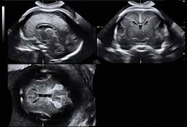 Die weiterführende, differenzierte organdiagnostik (auch fehlbildungsultraschall, feindiagnostik oder oft auch vereinfachend „großer ultraschall genannt). Ultraschalldiagnostik Im 2 Und 3 Schwangerschaftsdrittel