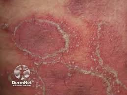Image result for Pustular Psoriasis