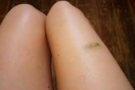Bleus Ecchymoses Causes Traitements Quand Faut Il S Inquieter