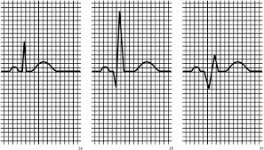 Needs to be present in at least 2 neighboring leads. Borderline Q Waves In Individuals Without Overt Cardiovascular Disease Relations With Adiposity Subclinical Atherosclerosis And Vascular Stiffness International Journal Of Cardiology