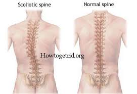 Scoliosis Is Derived From A Greek Word Meaning Curvature Affected Individuals Have An Abnormal Curvature Of Scoliosis Surgery Scoliosis Scoliosis Exercises