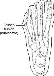 We did not find results for: Tailor S Bunion Bunionette Acfas