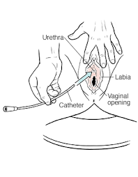 How to clean a catheter. Discharge Instructions Self Catheterization For Women Saint Luke S Health System