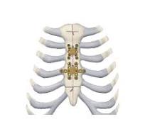 Placa de artrodesis para esternón - 460 series - Depuy ...