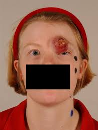 Maybe you would like to learn more about one of these? Merkel Cell Carcinoma In A Young Pregnant Woman Journal Of Plastic Reconstructive Aesthetic Surgery